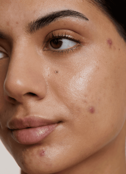 Acne Treatment Orem image 1