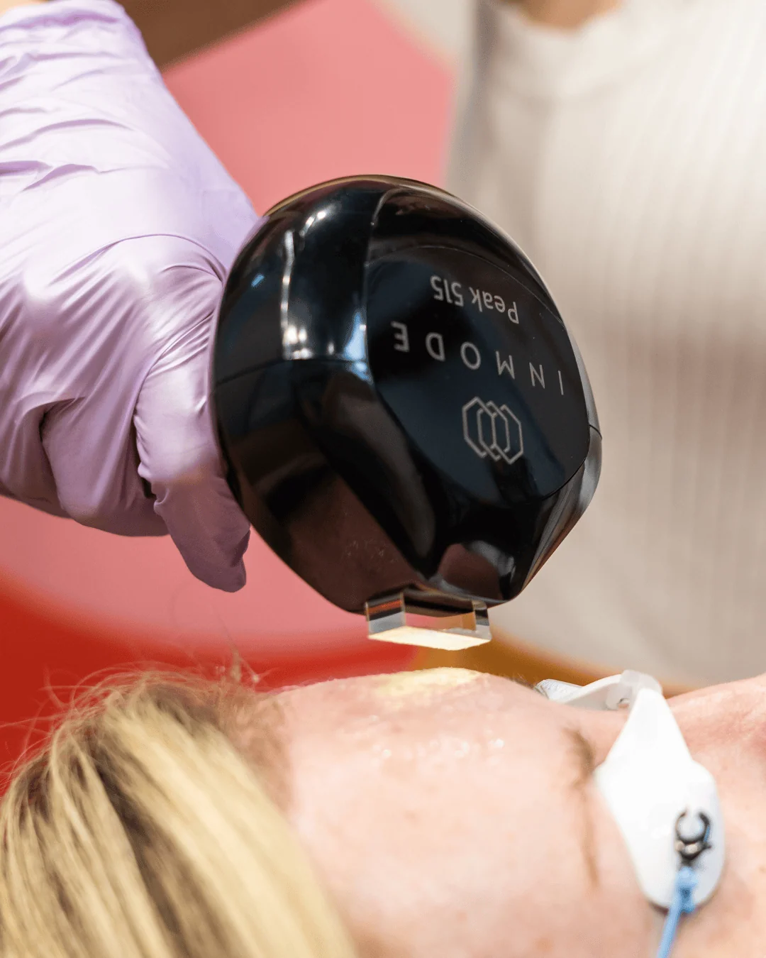Lumecca IPL Photofacial image 1